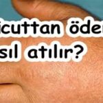 Ödem nasıl atılır