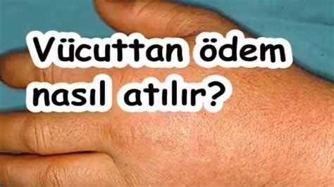 Ödem nasıl atılır